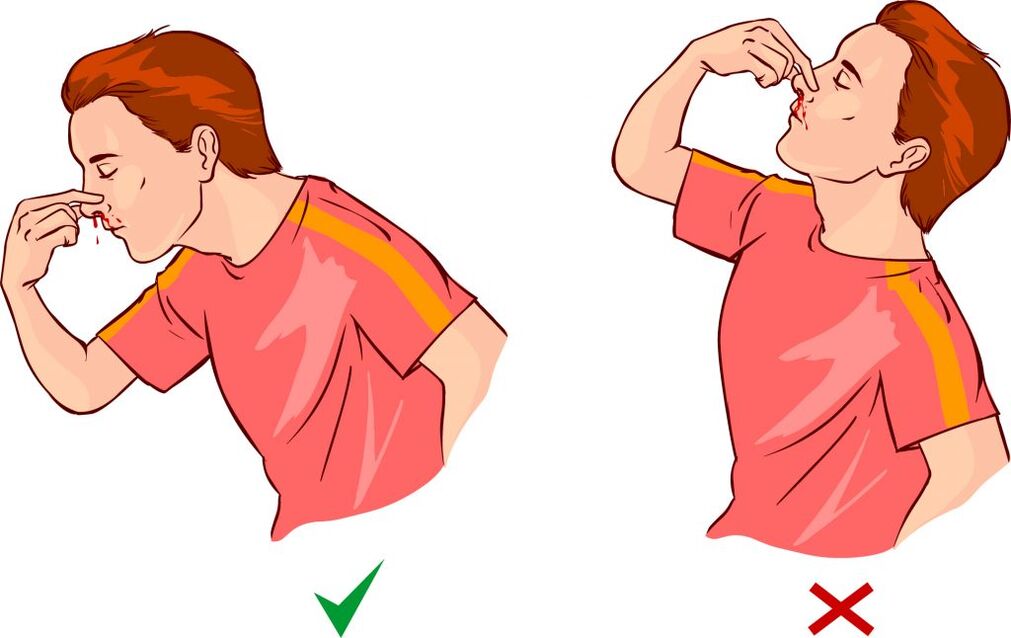 Epistaxis dla nadciśnienia
