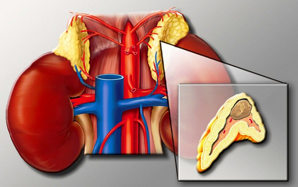 Feochromocytoma dla nadciśnienia