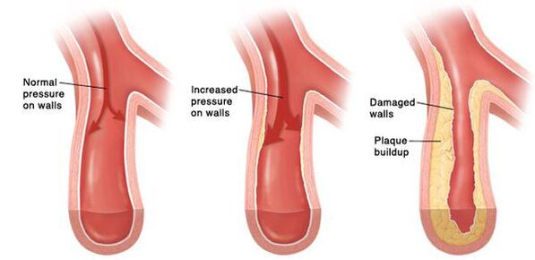 W nadciśnieniu dochodzi do naruszenia drożności łożyska naczyniowego